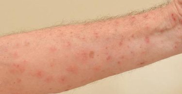 The significant difference between scabies and urticaria is based on their description. Scabies is described as skin rashes as a result of a mite referred to as Sarcoptes scarbiei. Urticaria, on the other hand, is described as a skin rash resulting from an allergic response to food or something individuals have touched. Skin rashes are usually red, dry, bumpy, inflamed, itchy, and painful.