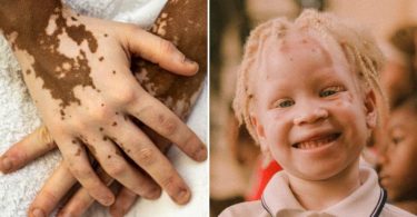 Difference Between Leucoderma and Albinism