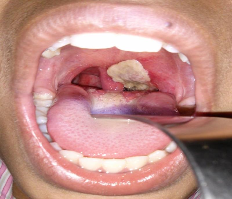 The significant difference between diphtheria and whooping cough indicates that diphtheria is a severe respiratory disease triggered by Corynebacterium diphtheriae. In contrast, whooping cough is a severe respiratory disease triggered by Bordetella pertussis. Respiratory disease is a disease in the body regions related to breathing, also described as respiratory, which may include the airways, throats, lungs, or sinuses. Pathogens that contain viruses or bacteria and fungi can contaminate the respiratory tract. Upper respiratory disease influences the upper regions of the respiratory tracts, which have to do with the nose, sinuses, and throat, whereas lower respiratory disease influences the airways and lungs. Diphtheria and whooping cough are two kinds of respiratory bacterial diseases.