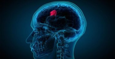 The significant difference between meningioma and glioma shows that meningioma is a tumour that begins from meninges encircling the brain and the spinal cord. Glioma, on the other hand, is a tumour that begins from glial cells in the spinal cord or in the brain.