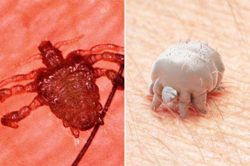 Difference Between Pubic Lice and Scabies