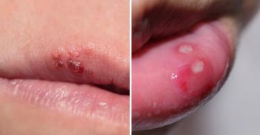 Difference Between Mouth Ulcer and Cold Sore