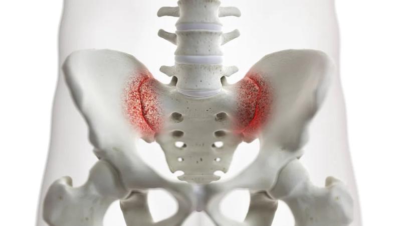 The significant difference between SI joint pain and piriformis syndrome indicates that SI joint pain leads to anguish in the downward part of the back, buttocks, and hips of the body as a result of arthritis or inflammation of the SI joint pain. In contrast, piriformis syndrome leads to anguish in the buttock and the downward part of the leg of the body as a result of the piriformis muscle condensing the sciatic nerves. SI joint pain and piriformis syndrome are two medical disorders that trigger pains in various body regions. They are as well connected to medical disorders as people with SI joint pain usually go through piriformis syndrome.