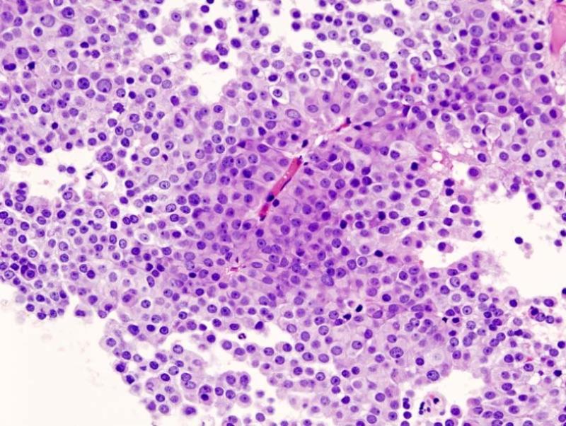 Difference Between Hypopituitarism and Hyperpituitarism