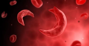 Sickle cell disease is a typical genetic hemoglobinopathy triggered by a point adaptation in beta-globin that stimulates the polymerization of deoxygenated haemoglobin resulting in red cell contortion, hemolytic anaemia, ischemic tissue deterioration, and microvascular blockage.