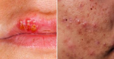 Difference Between Cold Sore and Pimple