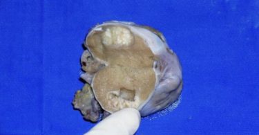 Difference Between Teratoma and Seminoma