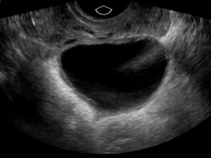 Difference Between Follicular Cyst and Luteal Cyst