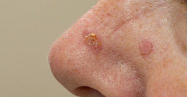 The significant difference between actinic disease and Bowen's disease indicates that actinic keratosis is a skin disorder that triggers smaller red, pink, skin-colored, or gray scaly, inflated dots on the skin.