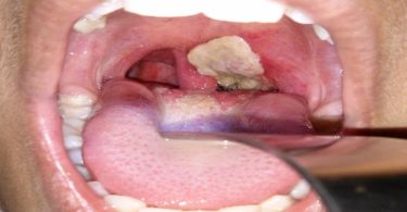 The significant difference between diphtheria and whooping cough indicates that diphtheria is a severe respiratory disease triggered by Corynebacterium diphtheriae. In contrast, whooping cough is a severe respiratory disease triggered by Bordetella pertussis. Respiratory disease is a disease in the body regions related to breathing, also described as respiratory, which may include the airways, throats, lungs, or sinuses. Pathogens that contain viruses or bacteria and fungi can contaminate the respiratory tract. Upper respiratory disease influences the upper regions of the respiratory tracts, which have to do with the nose, sinuses, and throat, whereas lower respiratory disease influences the airways and lungs. Diphtheria and whooping cough are two kinds of respiratory bacterial diseases.