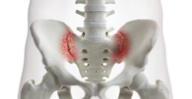 The significant difference between SI joint pain and piriformis syndrome indicates that SI joint pain leads to anguish in the downward part of the back, buttocks, and hips of the body as a result of arthritis or inflammation of the SI joint pain. In contrast, piriformis syndrome leads to anguish in the buttock and the downward part of the leg of the body as a result of the piriformis muscle condensing the sciatic nerves. SI joint pain and piriformis syndrome are two medical disorders that trigger pains in various body regions. They are as well connected to medical disorders as people with SI joint pain usually go through piriformis syndrome.