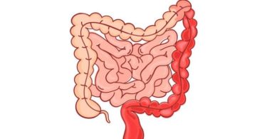 The primary difference between colitis and proctitis is that colitis is a medical disorder that influences the colon of the big intestine. In contrast, proctitis is a medical disorder that influences the rectum of the big intestine.